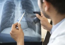 Anvisa aprova novo medicamento para câncer de pulmão avançado
